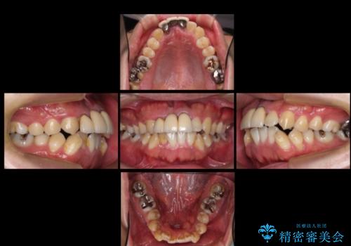 前歯ブリッジのやりかえ　下の歯のがたつき　銀歯を全てセラミックにの症例 治療前