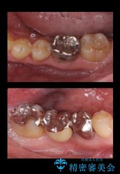 50代男性 受け口 他院で5年以上かかると治療を断られたの治療前