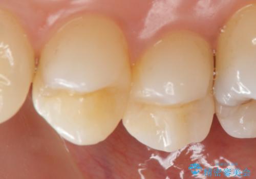 X線撮影によりわかる、内在する虫歯治療の治療後