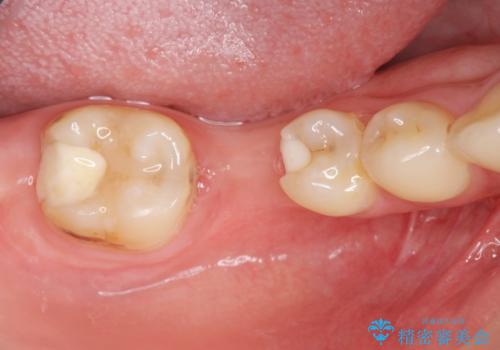 インプラントを用いた臼歯部欠損補綴の治療前
