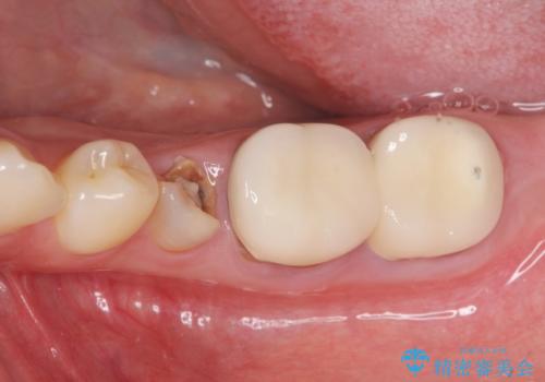 歯ぐきからの出血 歯周外科による改善の治療前