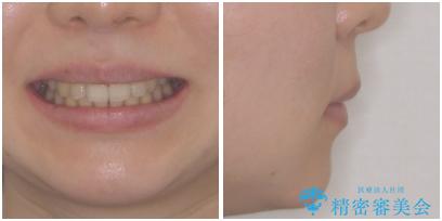 気になる八重歯を治したい ワイヤー装置での抜歯矯正の治療後(顔貌)