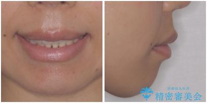 前歯のデコボコを治したい 費用を抑えた抜歯矯正の治療後(顔貌)