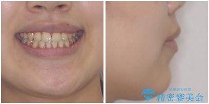 口元をスッキリと ワイヤーでの抜歯矯正の治療後(顔貌)