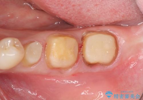 歯ぐきからの出血 歯周外科による改善の治療中