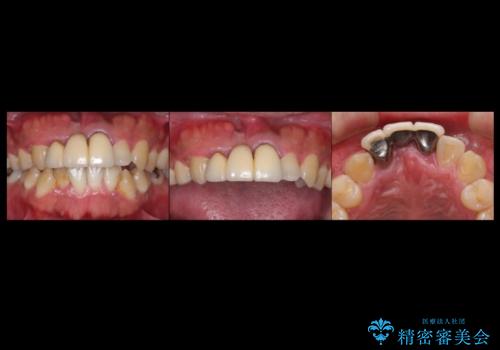 前歯ブリッジのやりかえ　下の歯のがたつき　銀歯を全てセラミックにの治療前