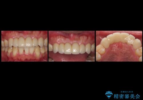 前歯ブリッジのやりかえ 下の歯のがたつき 銀歯を全てセラミックにの治療後