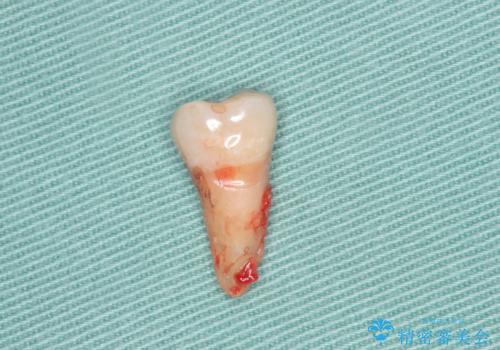 抜歯時歯槽堤保存術を用いた骨造成・インプラント治療