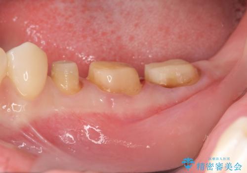 歯ぐきからの出血 歯周外科による改善の治療中
