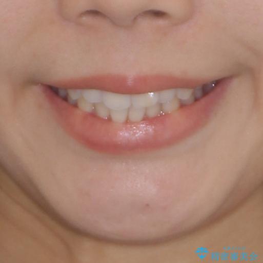 前歯のデコボコと突出感　インビザラインで改善の治療前（顔貌）