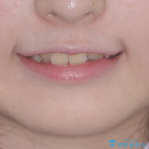 前歯をきれいに整えたい ワイヤー装置での非抜歯矯正の治療前(顔貌)