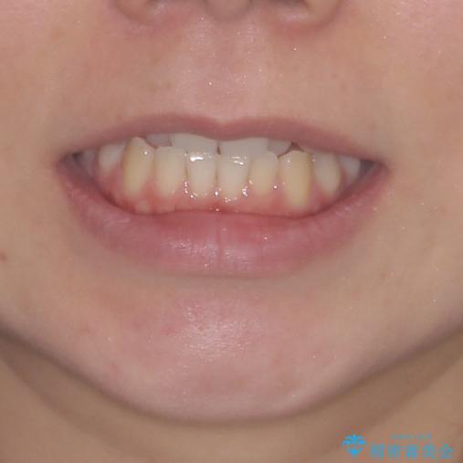 前歯のクロスバイトをインビザライン矯正で改善の治療前（顔貌）