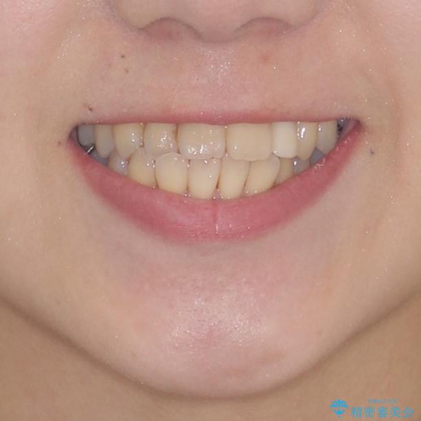 話しにくい歯並びの改善 抜歯矯正治療と前歯の審美治療の治療前(顔貌)