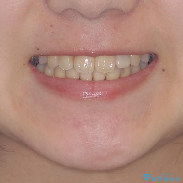 話しにくい歯並びの改善　抜歯矯正治療と前歯の審美治療の治療後（顔貌）
