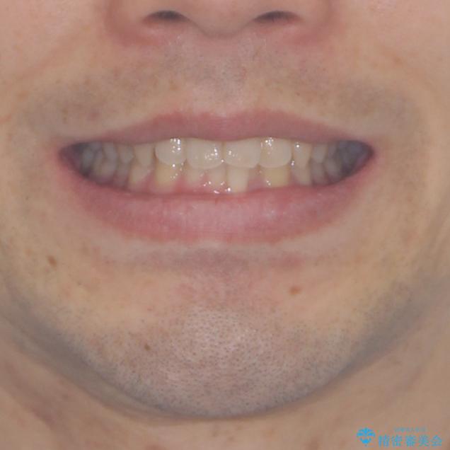 前歯の咬み合わせとデコボコを解消　インビザラインによる矯正治療の治療前（顔貌）