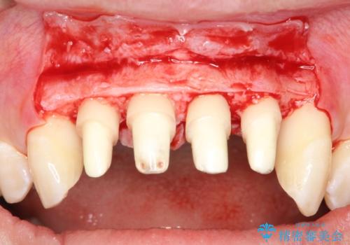 侵襲性歯周炎。前歯の歯周補綴
