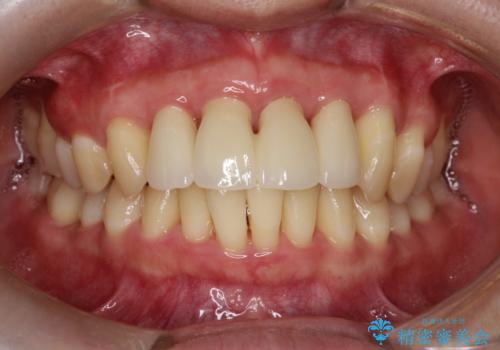 侵襲性歯周炎。前歯の歯周補綴の治療後