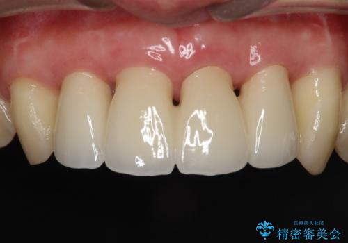 侵襲性歯周炎。前歯の歯周補綴の治療後