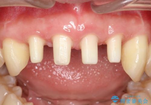 侵襲性歯周炎。前歯の歯周補綴の治療中