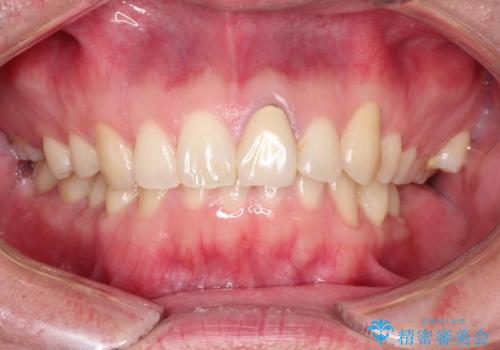 前歯が黒くなってきた。オールセラミッククラウンの治療前