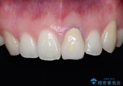 前歯が黒くなってきた。オールセラミッククラウンの治療前