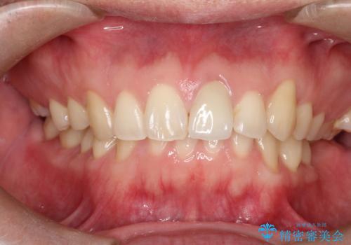 前歯が黒くなってきた。オールセラミッククラウンの治療後