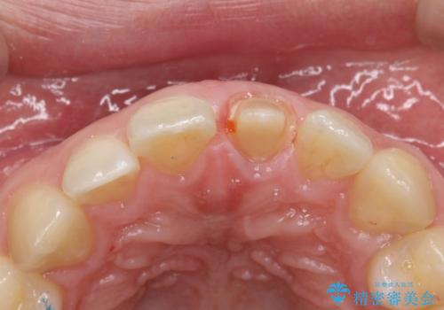 前歯が黒くなってきた。オールセラミッククラウンの治療中