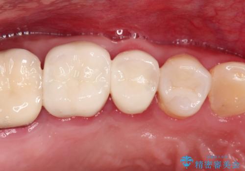 セラミッククラウン。虫歯の治療の症例 治療後