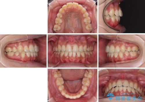 口元をスッキリと ワイヤーでの抜歯矯正の治療後