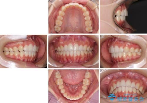 前歯のデコボコと突出感 インビザラインで改善の治療後