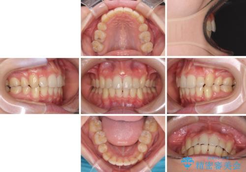 気になる八重歯を治したい ワイヤー装置での抜歯矯正の治療後