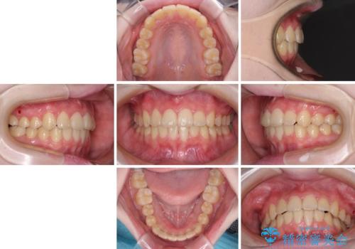 前歯をきれいに整えたい ワイヤー装置での非抜歯矯正の治療後
