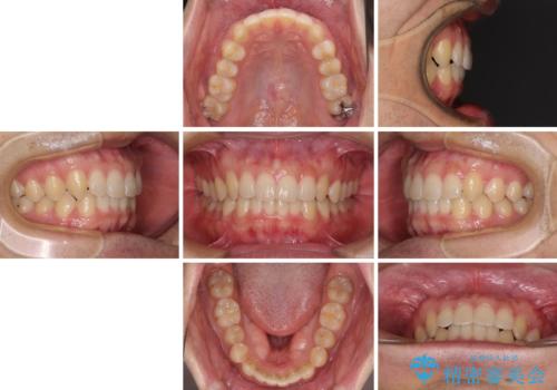 前歯の咬み合わせとデコボコを解消 インビザラインによる矯正治療の治療後