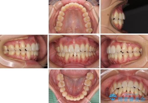 前歯のデコボコを治したい 費用を抑えた抜歯矯正の治療後