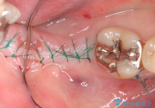 抜歯時歯槽堤保存術を用いた骨造成・インプラント治療の治療中