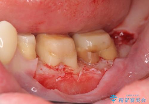 歯ぐきからの出血 歯周外科による改善の治療中