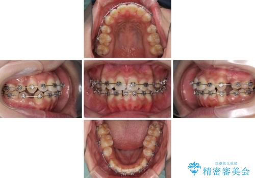 口元をスッキリと ワイヤーでの抜歯矯正の治療中