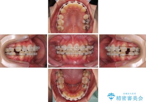 どんなに磨いても汚れが溜まる　抜歯矯正で清潔な口元にの治療中