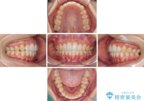 前歯のデコボコと突出感 インビザラインで改善の治療中