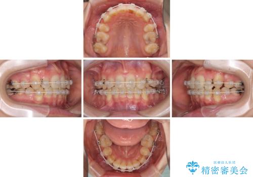 気になる八重歯を治したい ワイヤー装置での抜歯矯正の治療中
