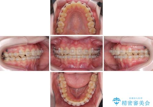 前歯をきれいに整えたい ワイヤー装置での非抜歯矯正の治療中