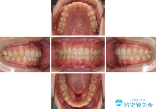 前歯の咬み合わせとデコボコを解消 インビザラインによる矯正治療の治療中