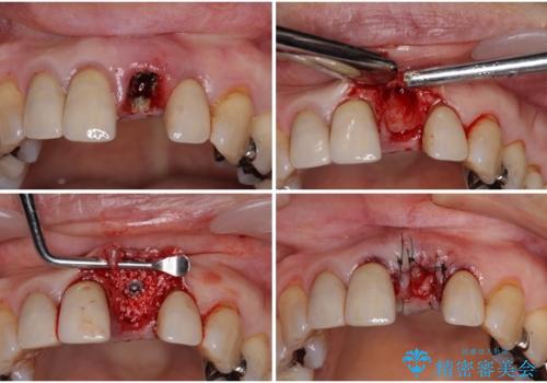 折れてしまった前歯 インプラントによる補綴治療の治療中