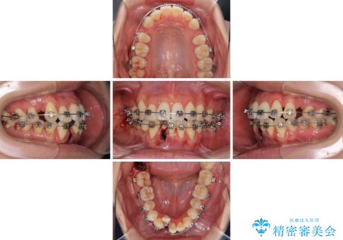 前歯のデコボコを治したい 費用を抑えた抜歯矯正の治療中