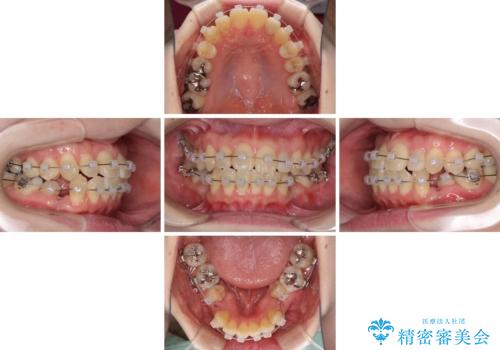 話しにくい歯並びの改善 抜歯矯正治療と前歯の審美治療の治療中