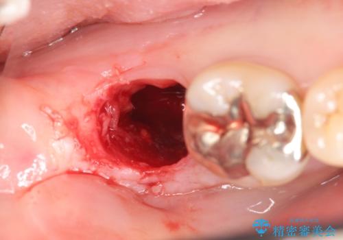抜歯時歯槽堤保存術を用いた骨造成・インプラント治療の治療前