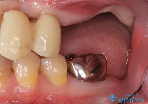 [入れ歯にしたくない] 臼歯部インプラント補綴の治療前