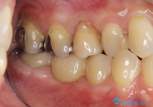 セラミックブリッジによる審美・咬合機能回復治療の治療後