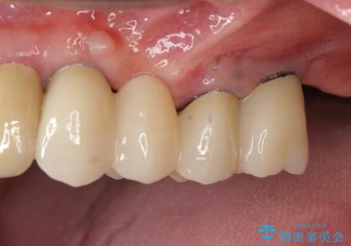 [入れ歯にしたくない] 臼歯部インプラント補綴の症例 治療後