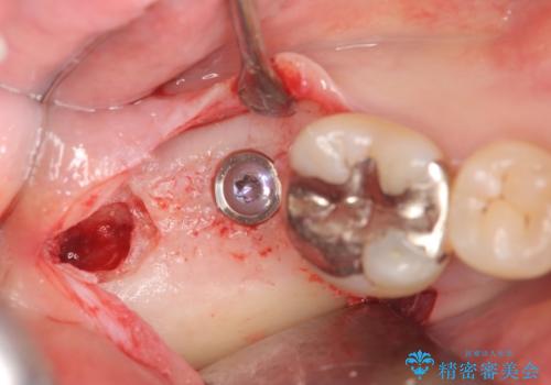 抜歯時歯槽堤保存術を用いた骨造成・インプラント治療の治療中